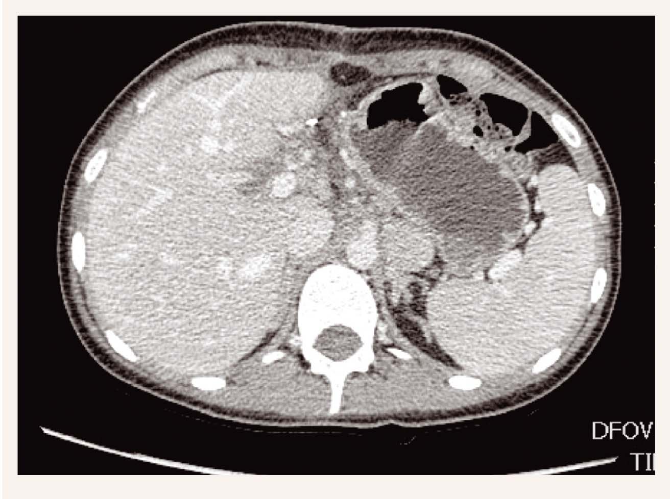 Krūškurvja un vēdera dobuma DT, kur redz, ka aknās pēc rezekcijas saglabājas viens limfmezgls paraaortāli