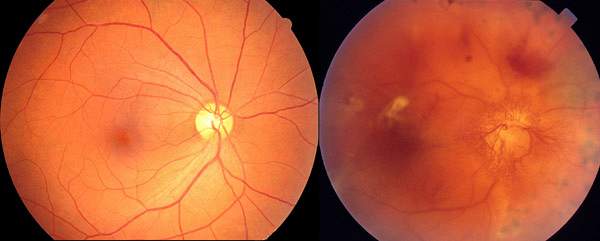 Pētījums: diabētiskas retinopātijas skrīninga efektivitāte 2.tipa cukura diabēta pacientiem