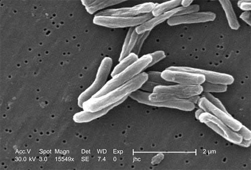 Pieaug saslimstība ar daudzlokalizāciju tuberkulozi