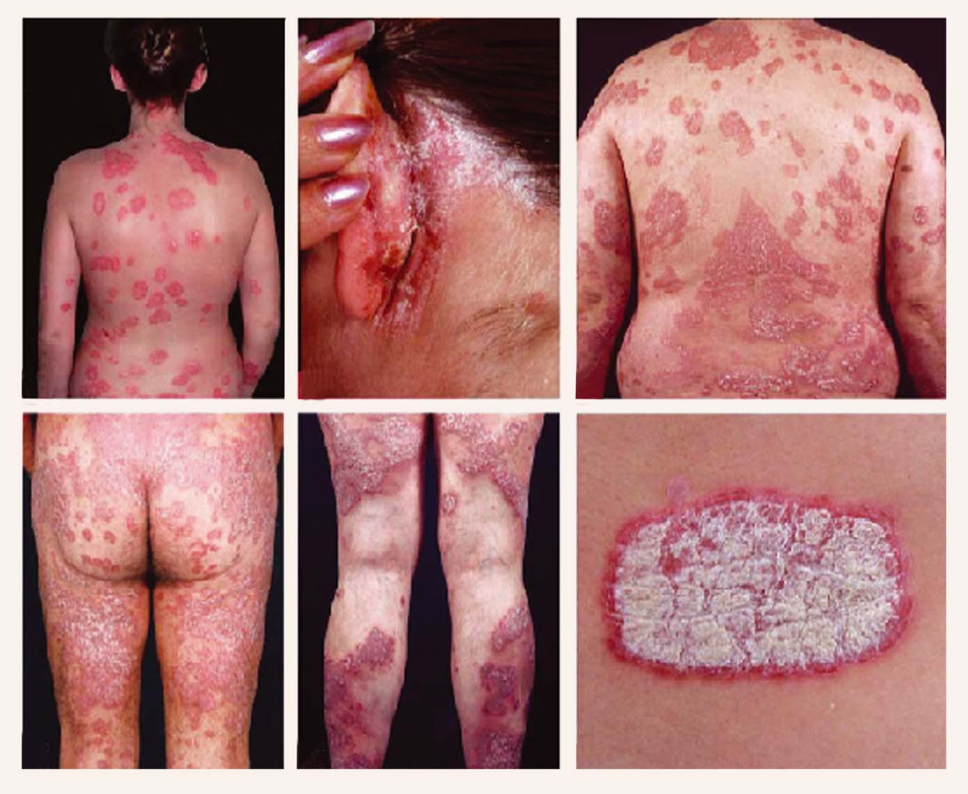 Psoriasis vulgaris raksturīgais ādas bojājums un biežāk  sastopamās ādas iekaisuma lokalizācijas vietas uz ķermeņa [1]