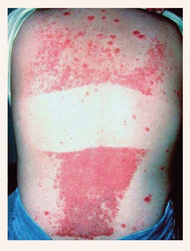 Kebnera fenomens: strauja psoriāzes klīniskās gaitas pasliktināšanās uz muguras pēc saules apdeguma, no saules pasargātā āda neskarta [1]