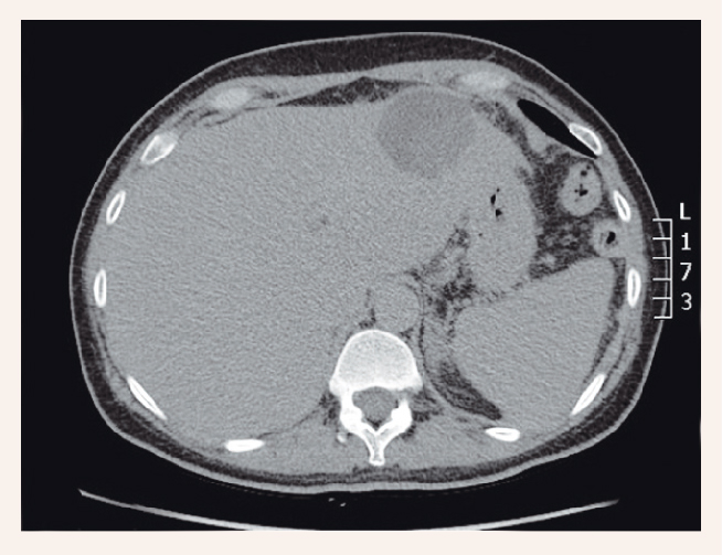 Vēdera dobuma datortomogrāfija: abscess kreisajā aknu daivā ar labās aknu daivas pazeminātu vaskularizāciju