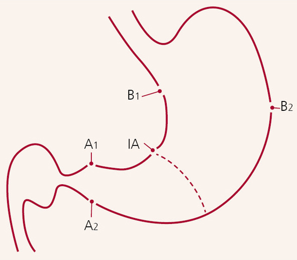 Rekomendējamās biopsijas vietas  pēc Sidnejas sistēmas:  divas no antrum (A1, A2),  viena no incisura (IA),  divas no ķermeņa (B1, B2) [16]