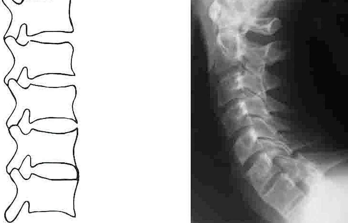 AS kakla un jostas daļas rentgenoloģisks novērtējums  (mSASSS  (modified Stoke Ankylosing  Spondylitis Spinal Score)  (C2-Th1, Th12–S1 LL projekcijā)