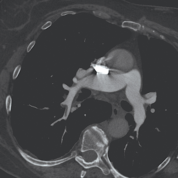 DT angiogrāfija plaušu artērijām. Redzamas plaušu artēriju oklūzijas abu daivu segmentārajos zaros