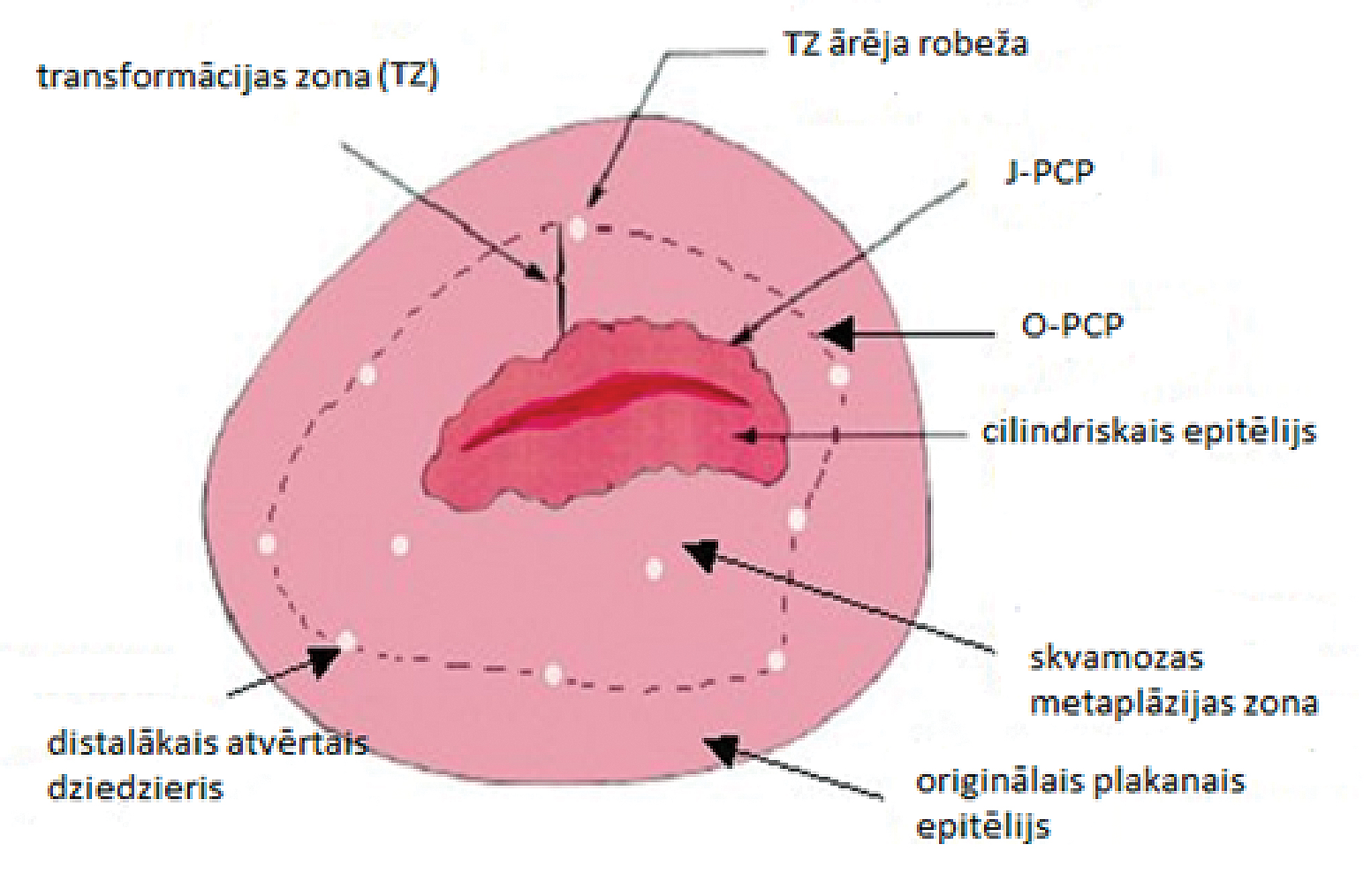 Transformācijas zona iezīmēta  starp divām atzīmēm:  oriģinālo plakanā–cilindriskā  epitēlija pāreju (O–PCP)  un jauno plakanā–cilindriskā  epitēlija pāreju (J–PCP)