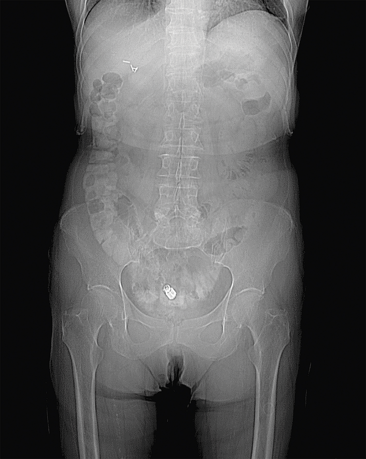 Datortomogrāfijas pārskata attēls  vēdera dobumam  un mazajam iegurnim. Kapsulas video  endoskops tievās zarnas cilpā