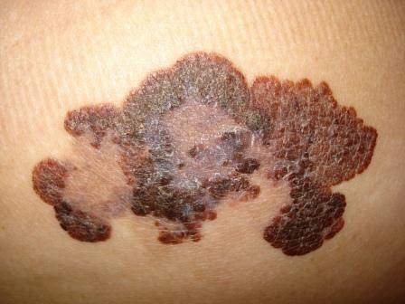 Pieaug ar ādas vēzi saslimušo pacientu skaits