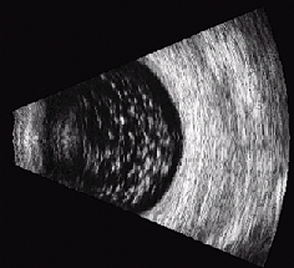 Acs ultrasonogrāfija.  Asteroīdā hialoze [8]