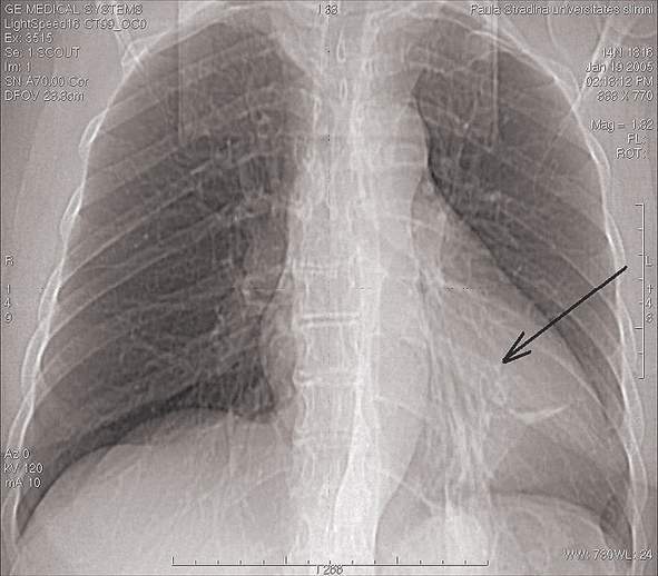 Plaušu vēža skrīnings  ar mazas starojuma  devas datortomogrāfiju