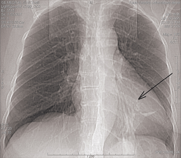 Hipoventilācija ar plaušu zīmējuma deformāciju kreisajā lejasdaivā