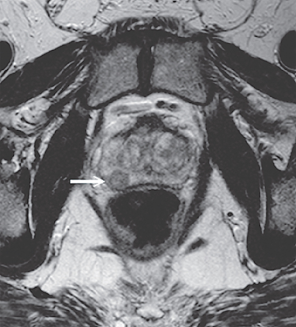 MR izmeklējums.  T2 uzsvērtā attēlā aksiālajā plaknē  redzams priekšdziedzera vēzis  labās puses perifērajā zonā [22]
