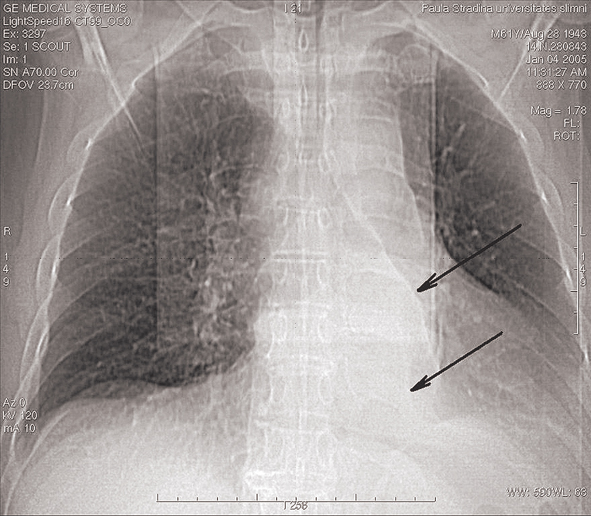 Paravertebrāls aizēnojums,  kreisajā pusē –  iespējama plaušas daļas atelektāze