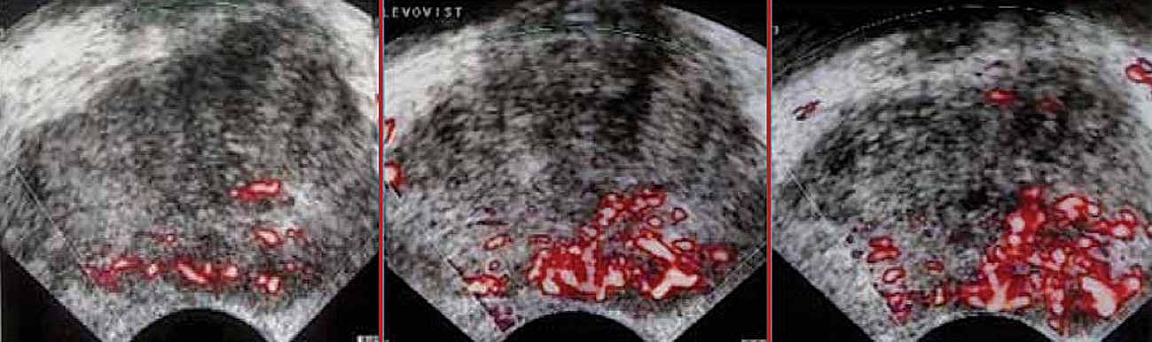 Ehokontrasta ultrasonoskopijas izmeklējums PV gadījumā. [6]  Transverss prostatas US attēls pēc i/v kontrastvielas ievades.  Kreisajā daivā pie dorsālās kontūras pēc kontrastvielas ievades  redzams hipervaskularizētu audu apvidus