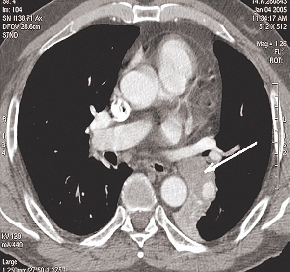 Centrāls plaušu audzējs kreisajā  lejas daivā ar totālu daivas  atelektāzi lejas daivas bronhā
