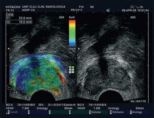 Tipiska prostatas vēža (karcinomas) sonoelastogrāfija:  asimetriska labā daiva,  vairāk nekā 1 cm izmainīti  prostatas audi, kas aizdomīgi  uz malignitāti katrā dimensijā [19]