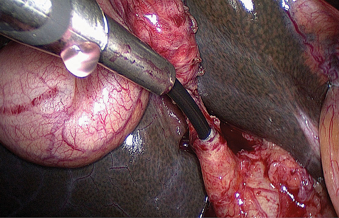 Holedohoskopija.  Pēc ductus cysticus dilatācijas  caur troakāru ievada holedohoskopu  un nokļūst kopējā žultsvada  distalajā daļā