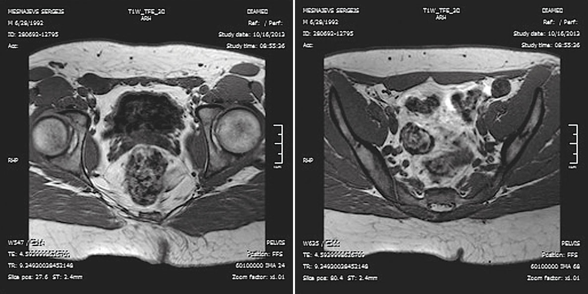 MR izmeklējums T1 uzsvērtā attēla  aksiālajā plaknē. Labajā pusē sēklinieks  ingvinālajā kanālā, kreisajā pusē –  vēdera dobumā pie priekšējās sienas