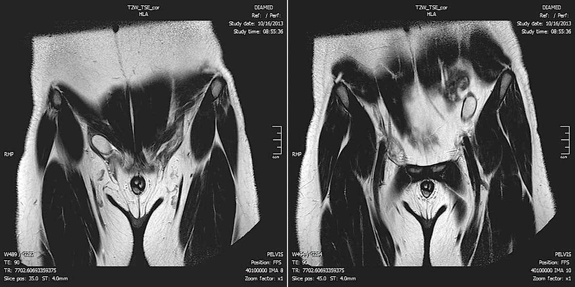 MR izmeklējums T2 uzsvērtā attēla  koronārajā plaknē. Labajā pusē sēklinieks  ingvinālajā kanālā, kreisajā pusē –  vēdera dobumā pie priekšējās sienas