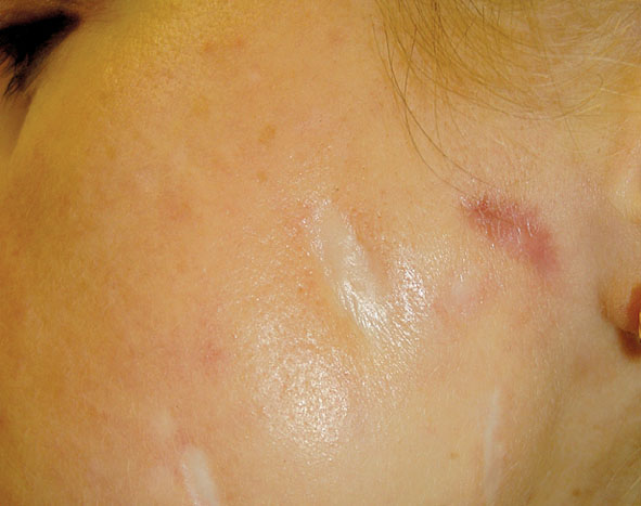 Dermatozoonozes murgu radīti  neīsti ādas bojājumi