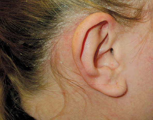 Seborejiskais dermatīts galvas matainajā  daļā 17 gadus vecai pacientei
