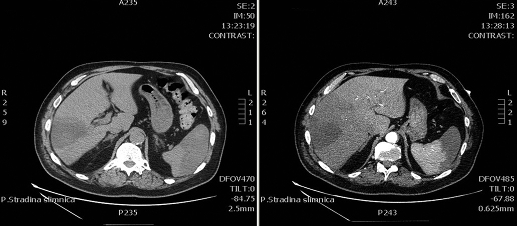 DT vēdera dobumam,  retroperitoneālajai telpai un DT angiogrāfija  23.09.2013.