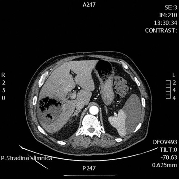 DT angiogrāfija  abdominālajai aortai un tās  viscerālajiem zariem 27.09.2013.