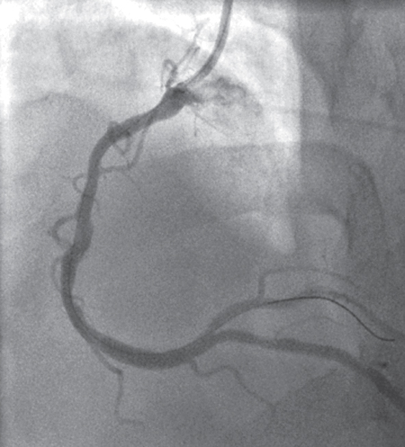 Labās koronārās artērijas angiogrāfija  pēc predilatācijas