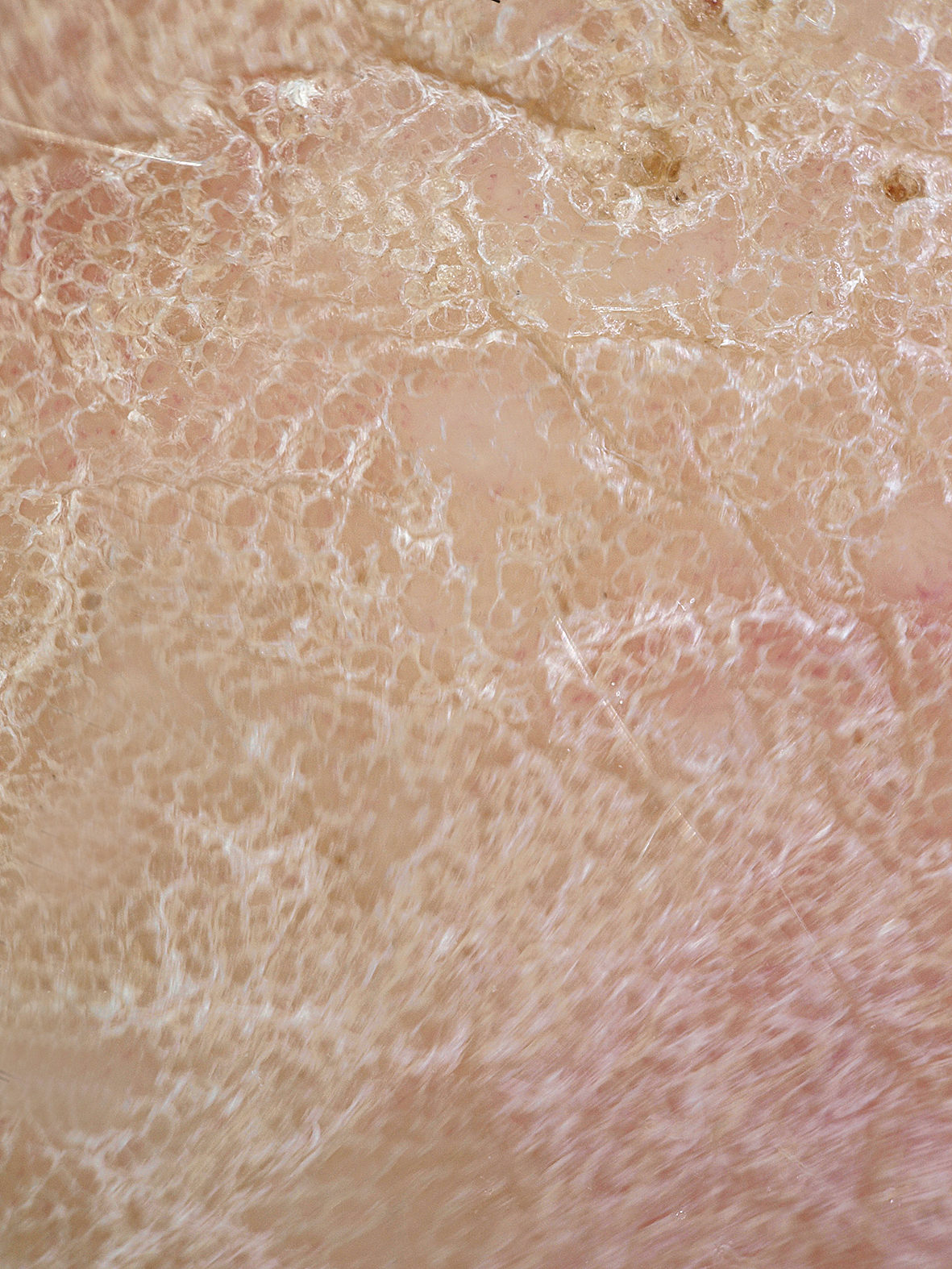 Plaukstas palmārās virsmas hiperkeratozes dermoskopijas aina