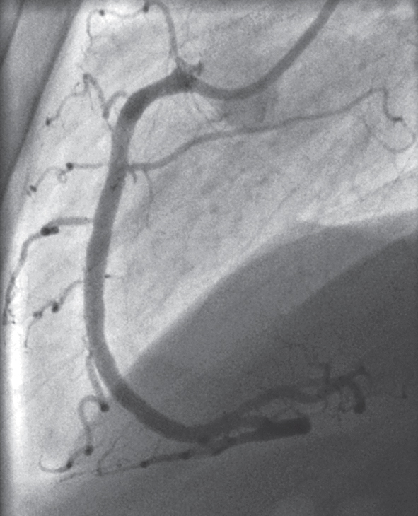 Labās koronārās artērijas angiogrāfija pēc divu  bioabsorbējošo stentu implantācijas un postdilatācijas