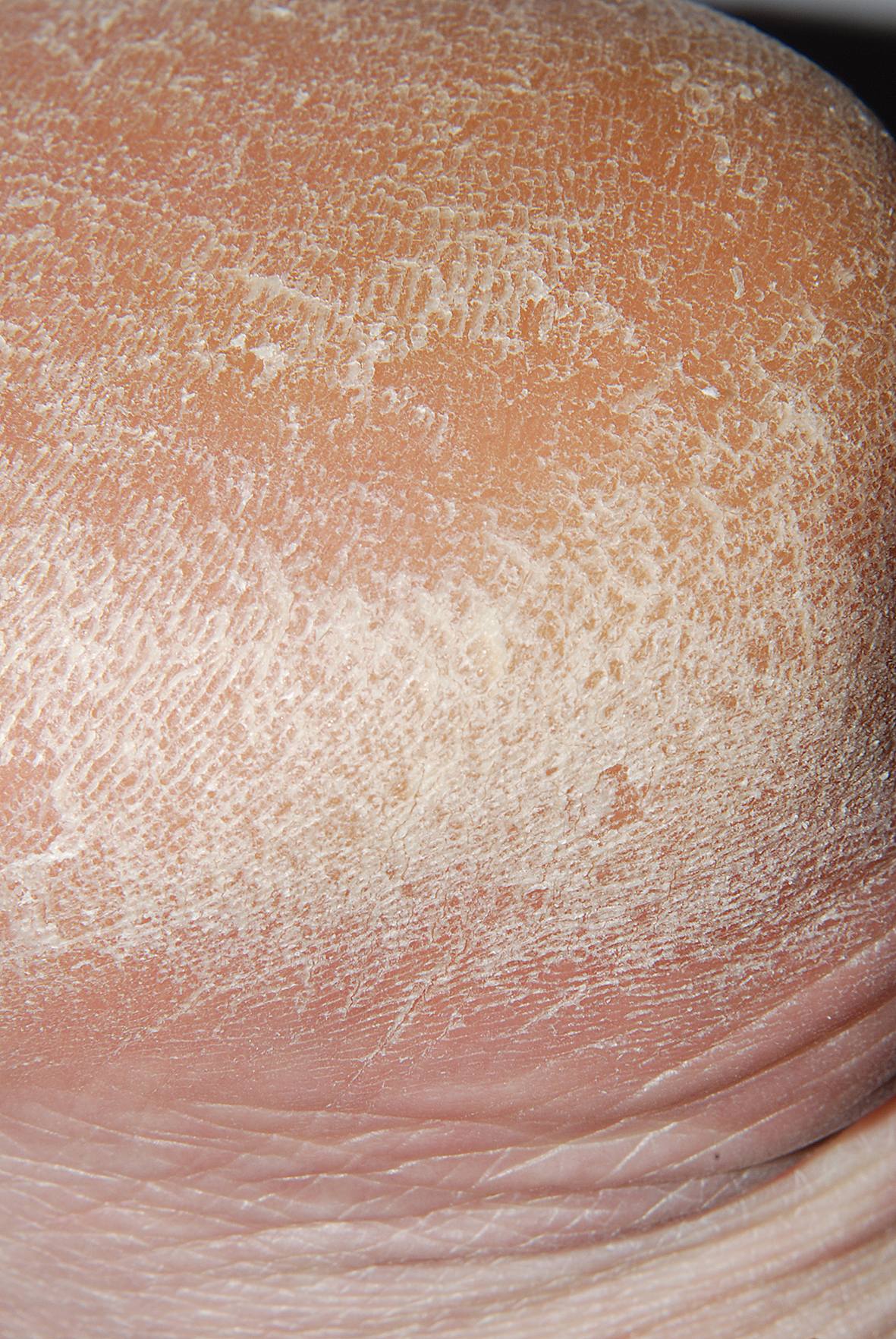 Pēdu ādas kseroze 56 gadus vecai pacientei