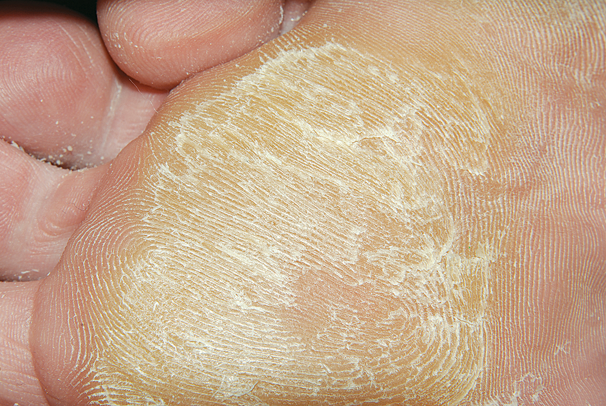 Pēdu ādas izteikta hiperkeratoze adipozai pacientei