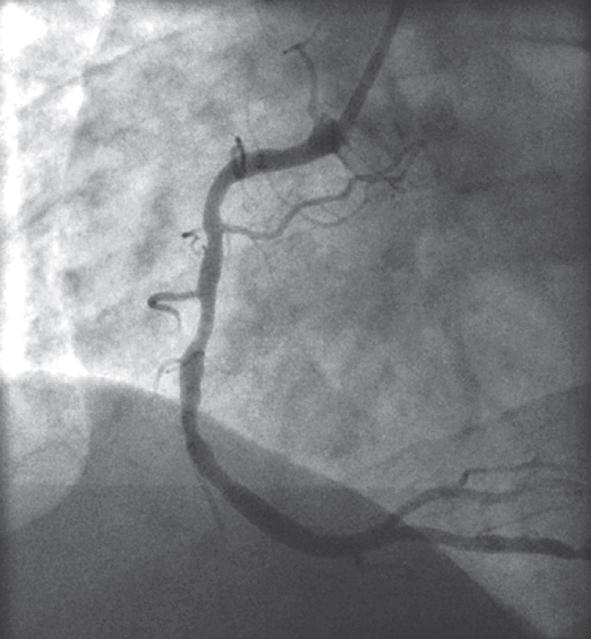 Labās koronārās artērijas angiogrāfija  pirms angioplastijas