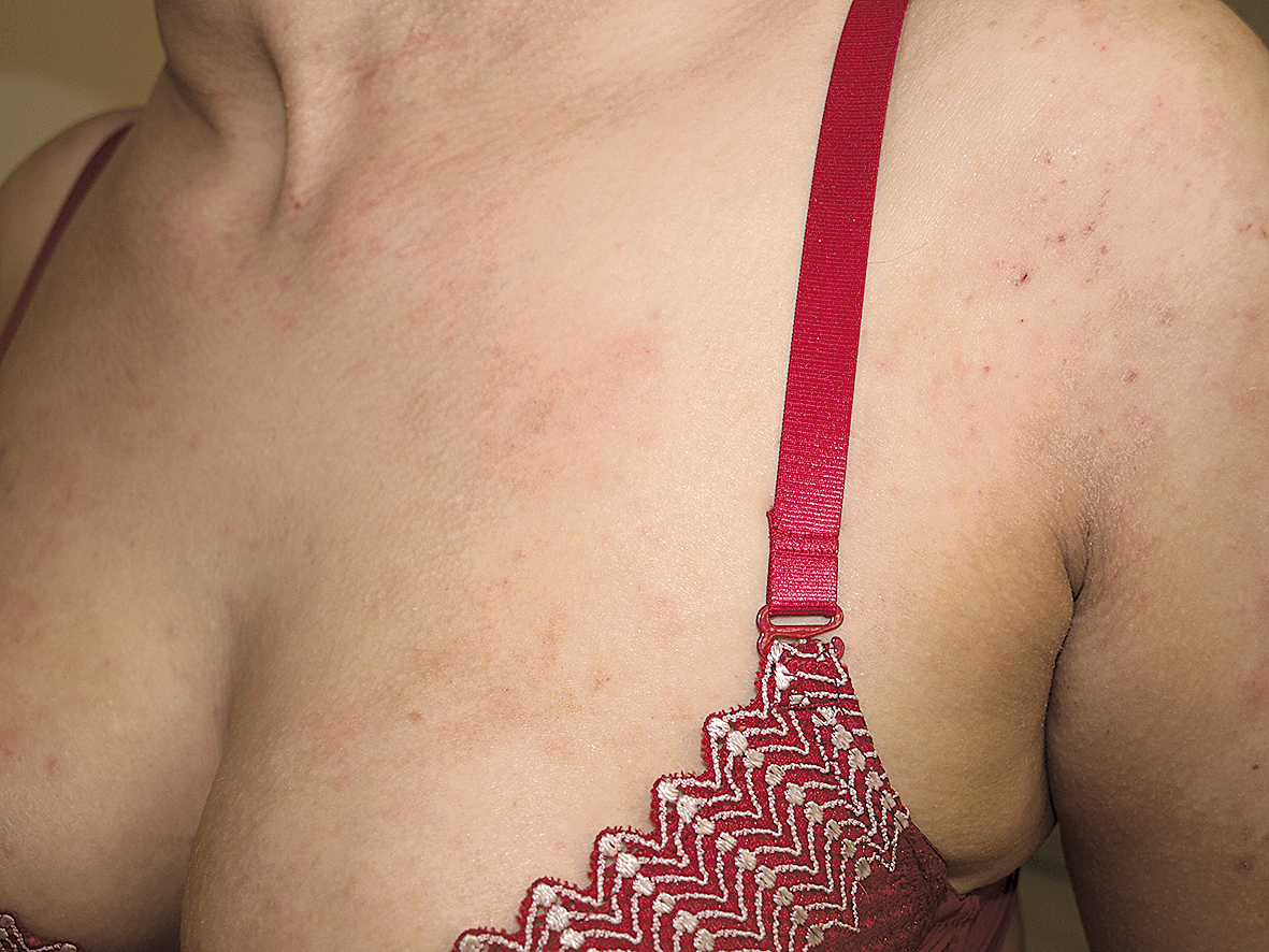 Atopiskā dermatīta ādas bojājums uz krūškurvja 26 gadus vecai pacientei