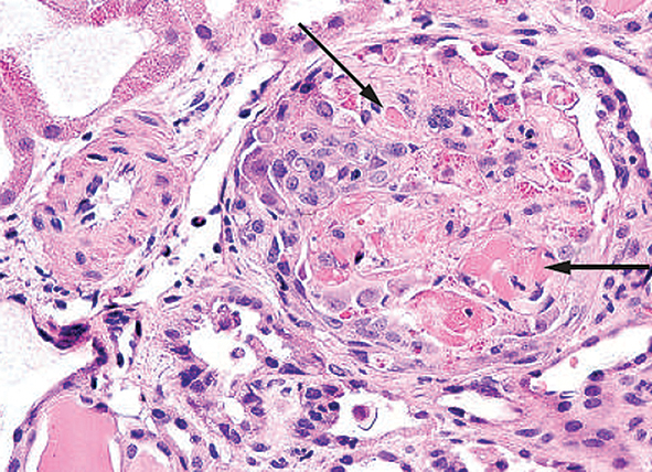 Ciklosporīna inducētas trombotiskas mikroangiopātijas aina ar hialīniem  trombiem glomerulu kapilāru cilpās.  Palielinājums 400 reizes [14]