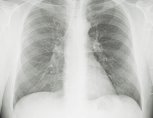 Krūškurvja kontroles  rentgenogramma:  iekaisuma process plaušu audos  praktiski uzsūcies