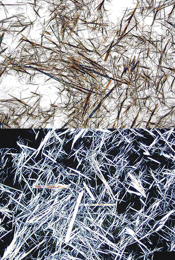 Kristalūrijas mikroskopiskā aina  2 stundas pēc aciklovira lietošanas.  Apakšējā attēlā urīna mikroskopiska izmeklēšana  polarizācijas gaismā
