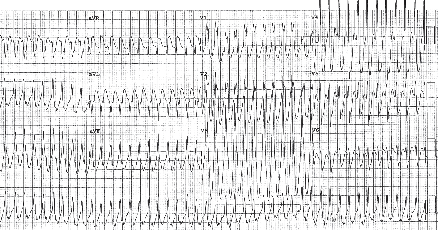 Elektrokardiogramma pacientiem ar WPW sindromu un priekškambaru mirdzaritmiju