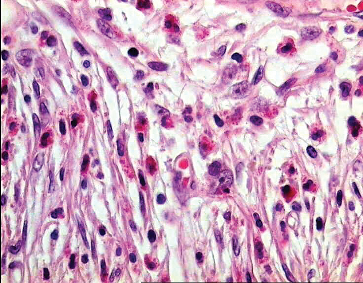 Eozinofilo leikocītu infiltrācija  starp vārpstveida šūnām.  Hematoksilīns–eozīns.  Attēla palielinājums 400 ×
