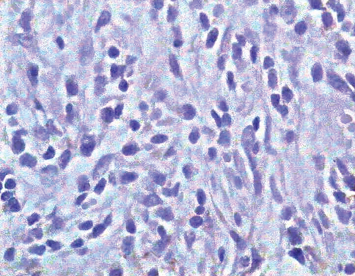 CD117 ekspresijas iztrūkums vārpstveida šūnās. Imūnperoksidāze. Attēla palielinājums 400 ×