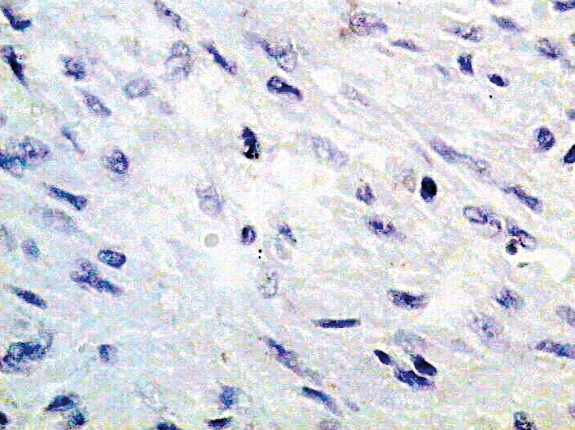 Pilnīgs kopējā citokeratīna AE1/AE3  iztrūkums audzēja šūnās. Imūnperoksidāze.  Attēla palielinājums 400 ×