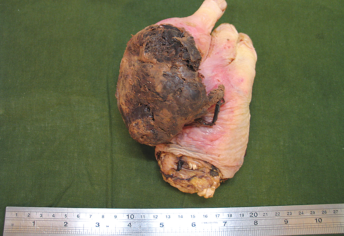 Kreisās plaukstas  amputācijas materiāls  ar audzēju ulnārajā pusē