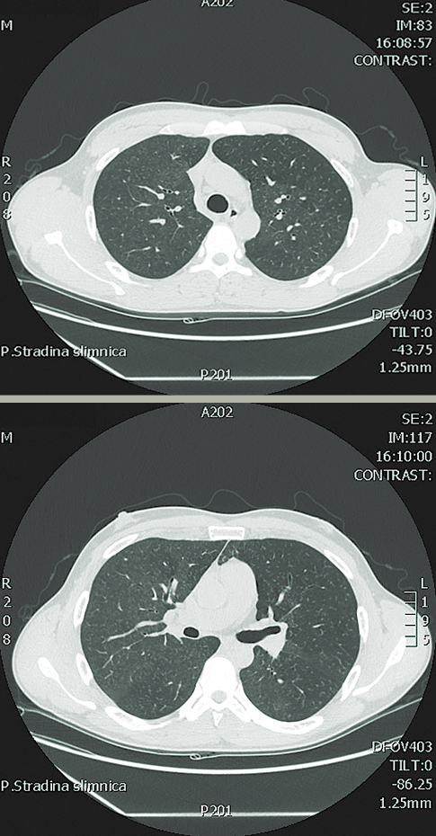 DT angiogrāfija plaušām  ar difūzām izmaiņām plaušās  ar hipo- un hiperpneimatizētiem  apvidiem