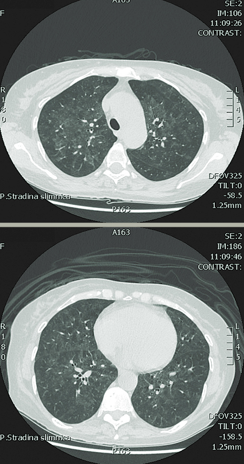 Plaušu DT — difūzas  matstikla tipa pārmaiņas  no plaušu augšlaukiem  līdz plaušu bazālajām daļām