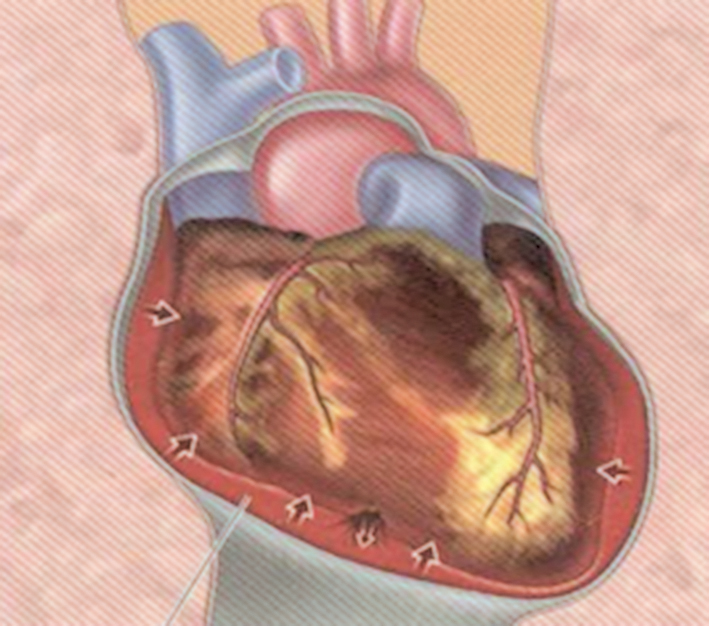 Hemoperikards  un sirds tamponāde  sirds dobuma plīsuma gadījumā