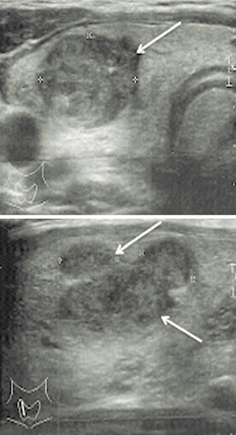 Vairogdziedzera punkcijas  biopsija USG kontrolē (12.05.2014.)