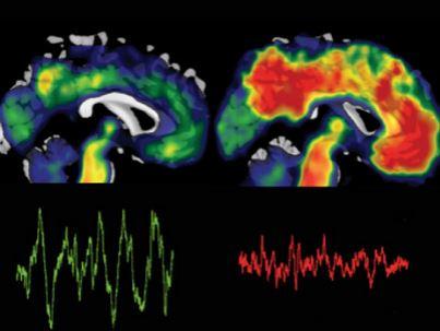 Attēls. Bēta amiloīda izgulsnēšanās galvas smadzenēs (attēla pa labi, sarkanā krāsā).