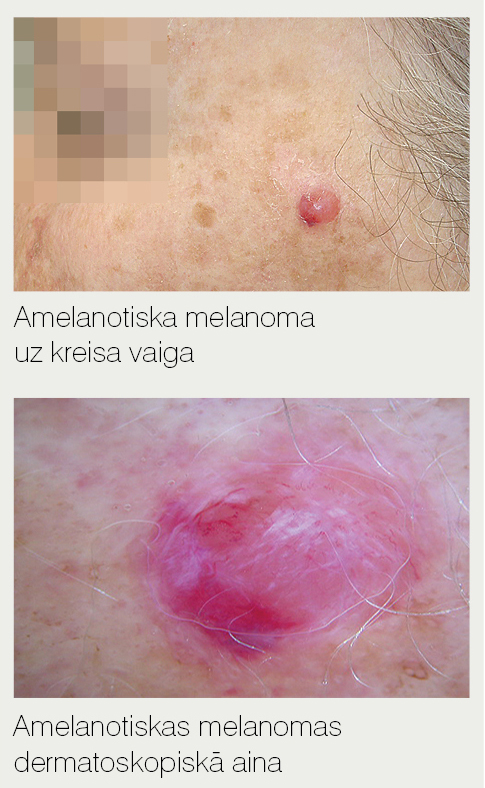 Amelanotiska melanoma