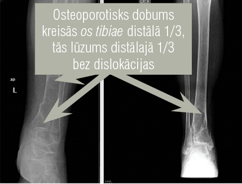 Osteoporotisks dobums  os tibiae distālajā daļā,  tās lūzums bez dislokācijas