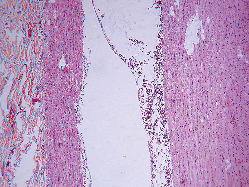 Aortas tunica media  atslāņošanās, tūska,  asinsizplūdumi,  neliela limfocitārā infiltrācija   (hematoksilīns—eozīns,  50 × palielinājums)
